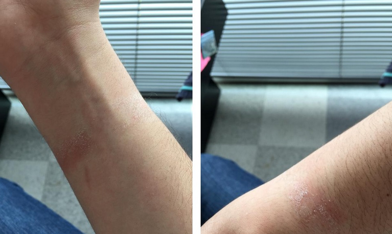 Some-Apple-Watch-wearers-are-experiencing-allergic-reactions-from-wearing-the-device-nbsp (1)
