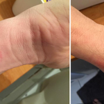 Some-Apple-Watch-wearers-are-experiencing-allergic-reactions-from-wearing-the-device-nbsp
