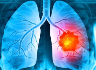 Καρκίνο Πνευμόνων καρκίνου