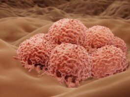 Έτοιμο για έγκριση το εμβόλιο που καταπολεμά το μελάνωμα (μορφή καρκίνου του δέρματος) μελάνωμα καρκίνο δέρματος