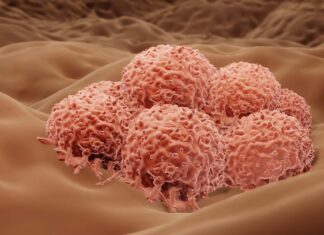 μελάνωμα καρκίνο δέρματος