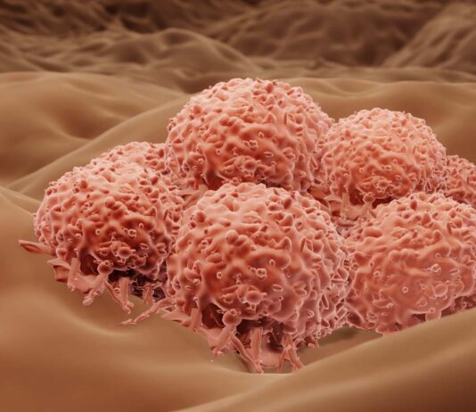 μελάνωμα καρκίνο δέρματος