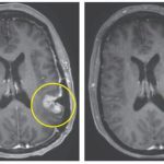 brain-cancer-tumor-500×320-1