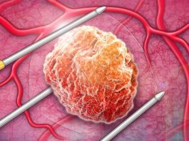 Νέα ελπίδα για την καταπολέμηση του καρκίνου με τη συμβολή του ανοσοποιητικού συστήματος καρκίνο προστάτη