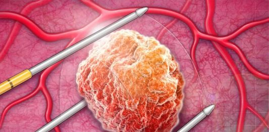 καρκίνο προστάτη