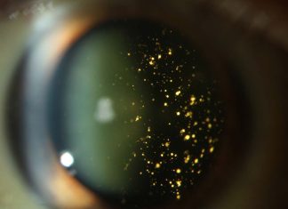 αστεροειδής υάλωση