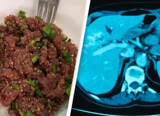 καρκίνο στο συκώτι