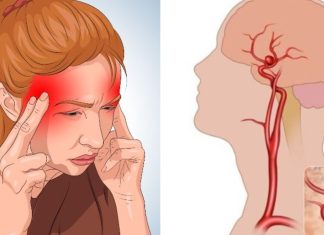 Ανεύρυσμα Εγκεφάλου