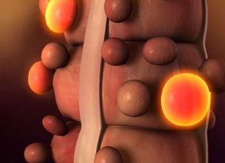 Καρκίνος παχέος εντέρου