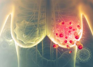 καρκίνου καρκίνο μαστού