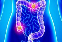 colon cancer πρόληψη
