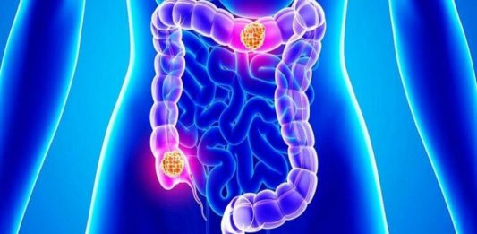 colon cancer πρόληψη