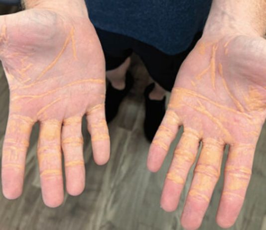 Να τι σημαίνει αν δεις αυτά τα σημάδια σε χέρια και πέλματα! σημάδια χέρια