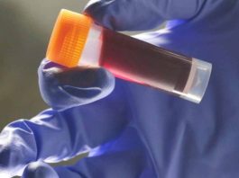 Μια ομάδα αίματος έχει μεγαλύτερο κίνδυνο για διαβήτη τύπου 2 κίνδυνο εγκεφαλικού ομάδα αίματος