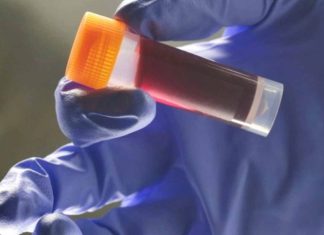 κίνδυνο εγκεφαλικού