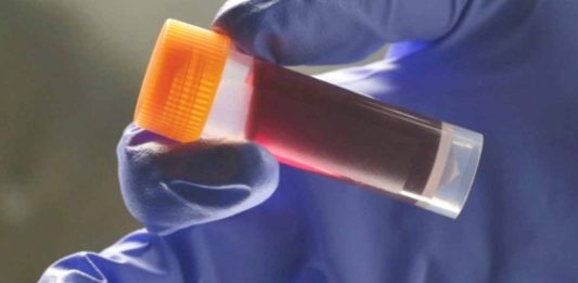 κίνδυνο εγκεφαλικού ομάδα αίματος