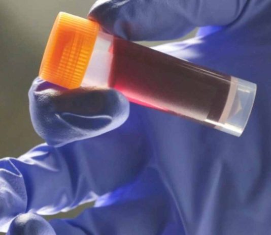 κίνδυνο εγκεφαλικού ομάδα αίματος