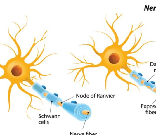 συμπτώματα πολλαπλής σκλήρυνσης