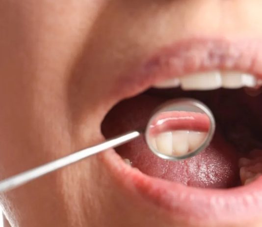 Τα πρώιμα συμπτώματα καρκίνου του στόματος: Αιτίες, διάγνωση και η σημασία της πρόληψης oran cancer