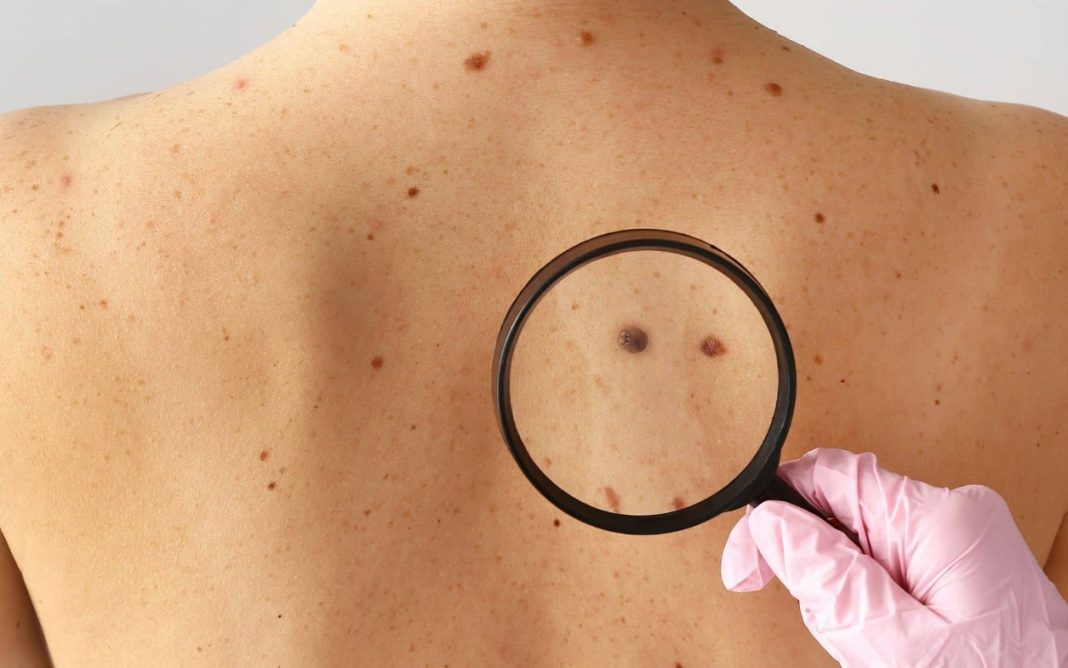 καρκίνο δέρματος