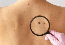 Ο ήλιος απενεργοποιεί αυτή την άμυνα απέναντι στον καρκίνο του δέρματος καρκίνο δέρματος