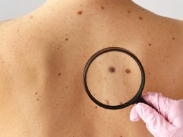 καρκίνο δέρματος