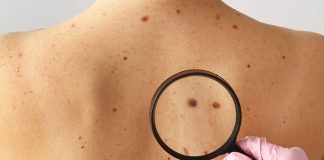 Ο ήλιος απενεργοποιεί αυτή την άμυνα απέναντι στον καρκίνο του δέρματος καρκίνο δέρματος