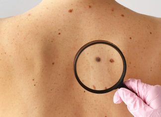 καρκίνο δέρματος