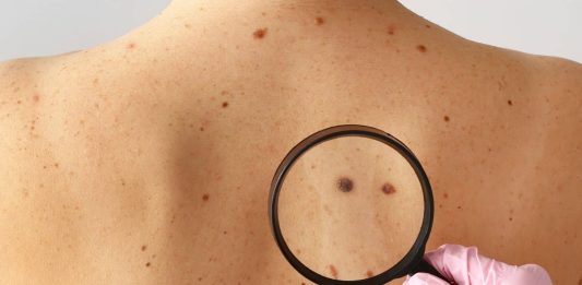 καρκίνο δέρματος