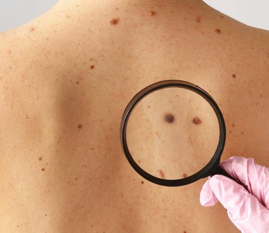 Ο ήλιος απενεργοποιεί αυτή την άμυνα απέναντι στον καρκίνο του δέρματος καρκίνο δέρματος