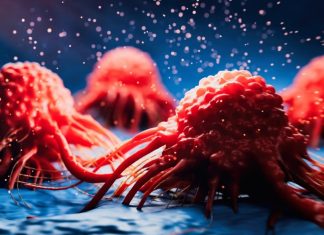 καρκίνος του παγκρέατος