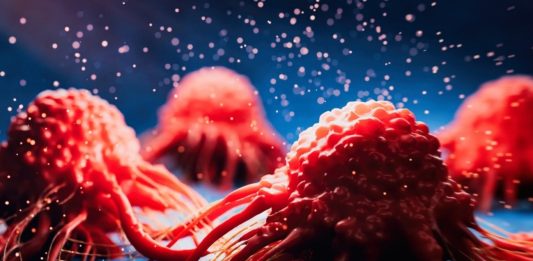 καρκίνος του παγκρέατος