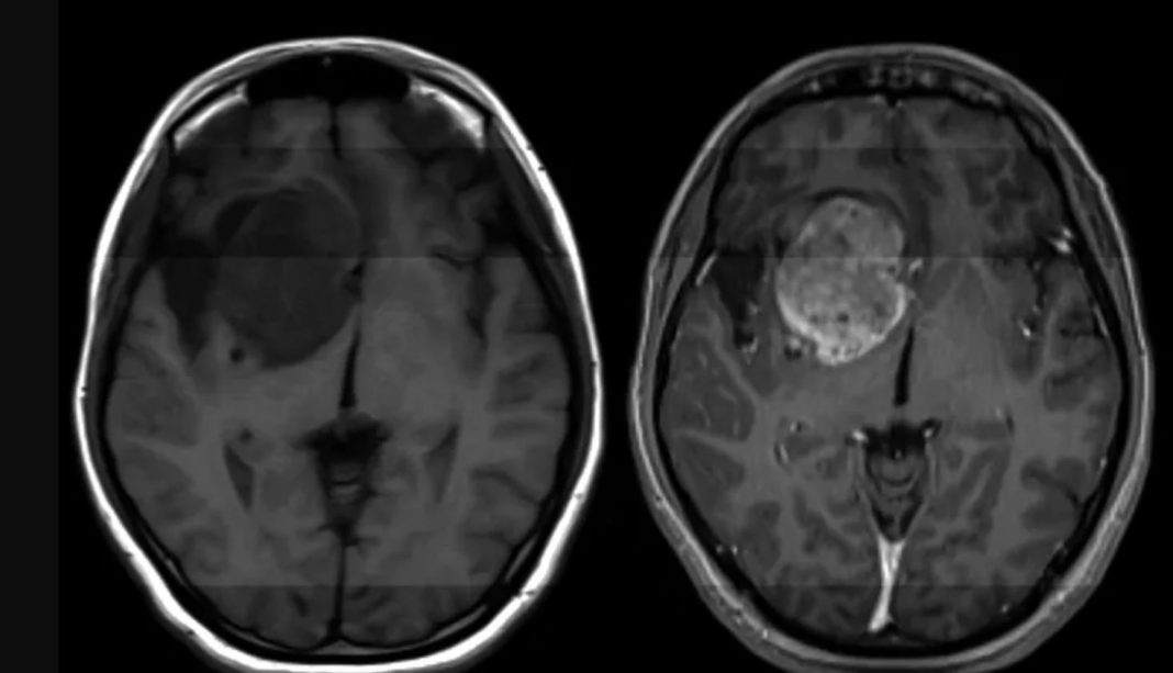 gloioblastwma Γλοιοβλάστωμα θεραπεία