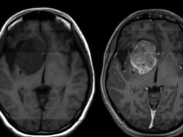 Γλοιοβλάστωμα θεραπεία