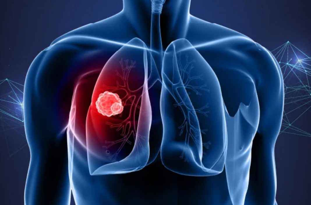 Καρκίνος του πνεύμονα: Η πρωτεΐνη ATF4 εξηγεί τις μεταστάσεις