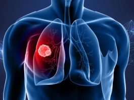 Καρκίνος του πνεύμονα: Η πρωτεΐνη ATF4 εξηγεί τις μεταστάσεις