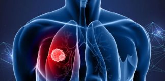 Καρκίνος του πνεύμονα: Η πρωτεΐνη ATF4 εξηγεί τις μεταστάσεις