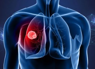 Καρκίνος του πνεύμονα: Η πρωτεΐνη ATF4 εξηγεί τις μεταστάσεις