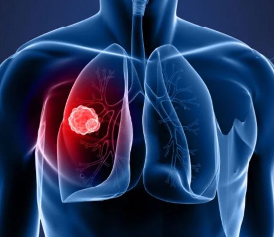 Καρκίνος του πνεύμονα: Η πρωτεΐνη ATF4 εξηγεί τις μεταστάσεις